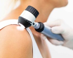 Eine Person mit weißem Handschuh untersucht mithilfe eines Dermatoskops einen Leberfleck auf der Schulter einer jungen Frau.